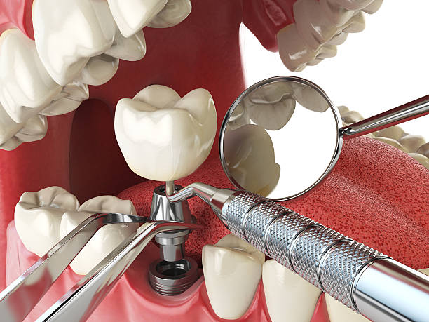 Best Emergency Dental Filling Replacement  in New Bremen, OH